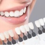 Types of Dental Veneers That Can Improve Your Smile
