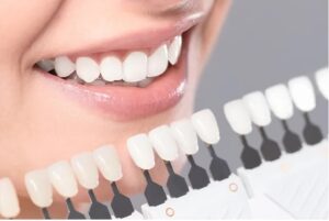 Types of Dental Veneers That Can Improve Your Smile